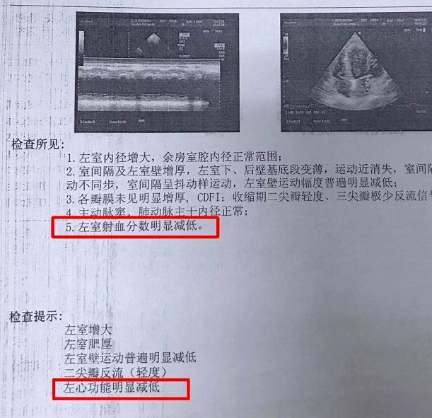 一文读懂心脏彩超报告中的"射血分数":ef越低,心功能越弱!