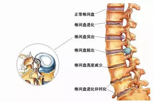 类风湿关节炎早期疼吗?要怎么缓解疼痛呢?