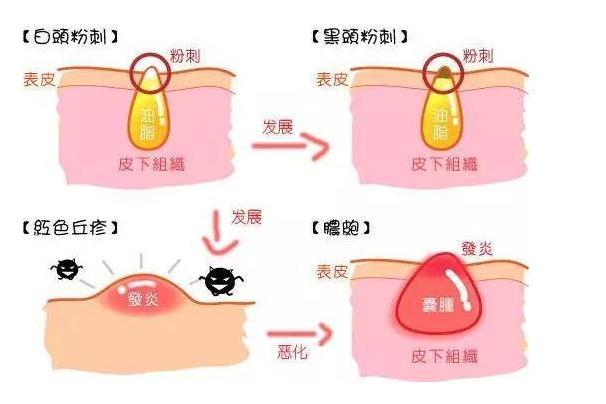 趣痘驿站告诉你:闭口是怎么"蜕变"的?