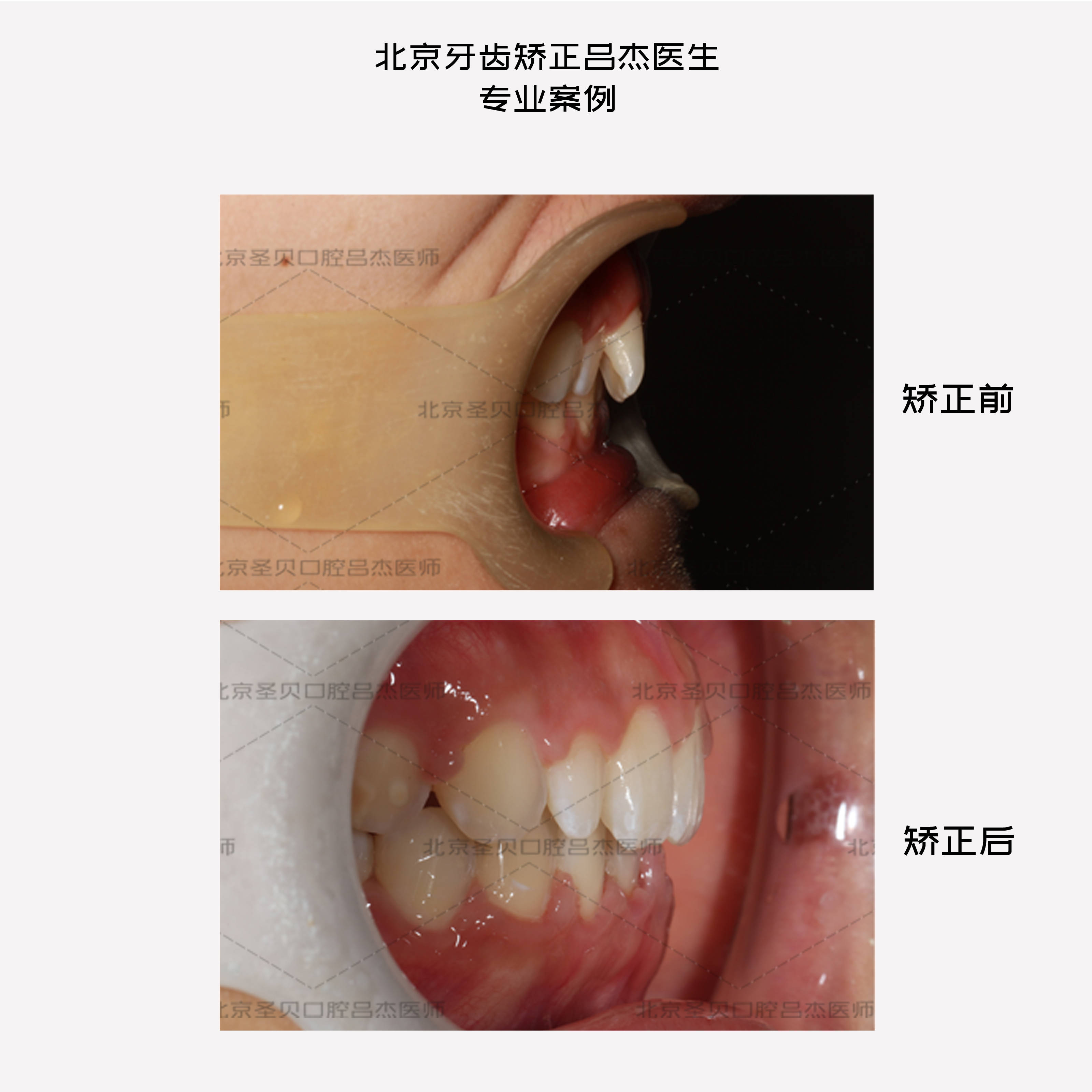 上切牙八字外翻 拥挤矫正案例