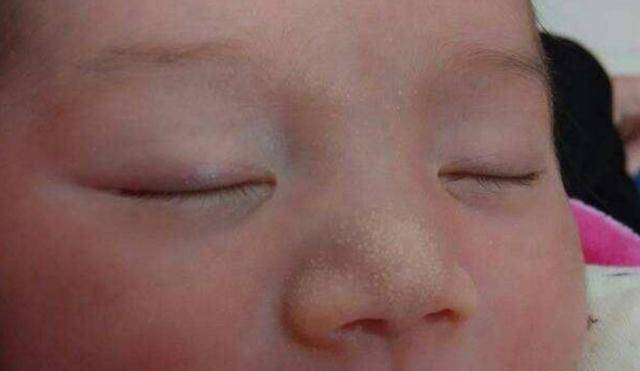 刚出生宝宝鼻子上就长脂肪粒？小白点到底是什么，妈妈别盲目处理
