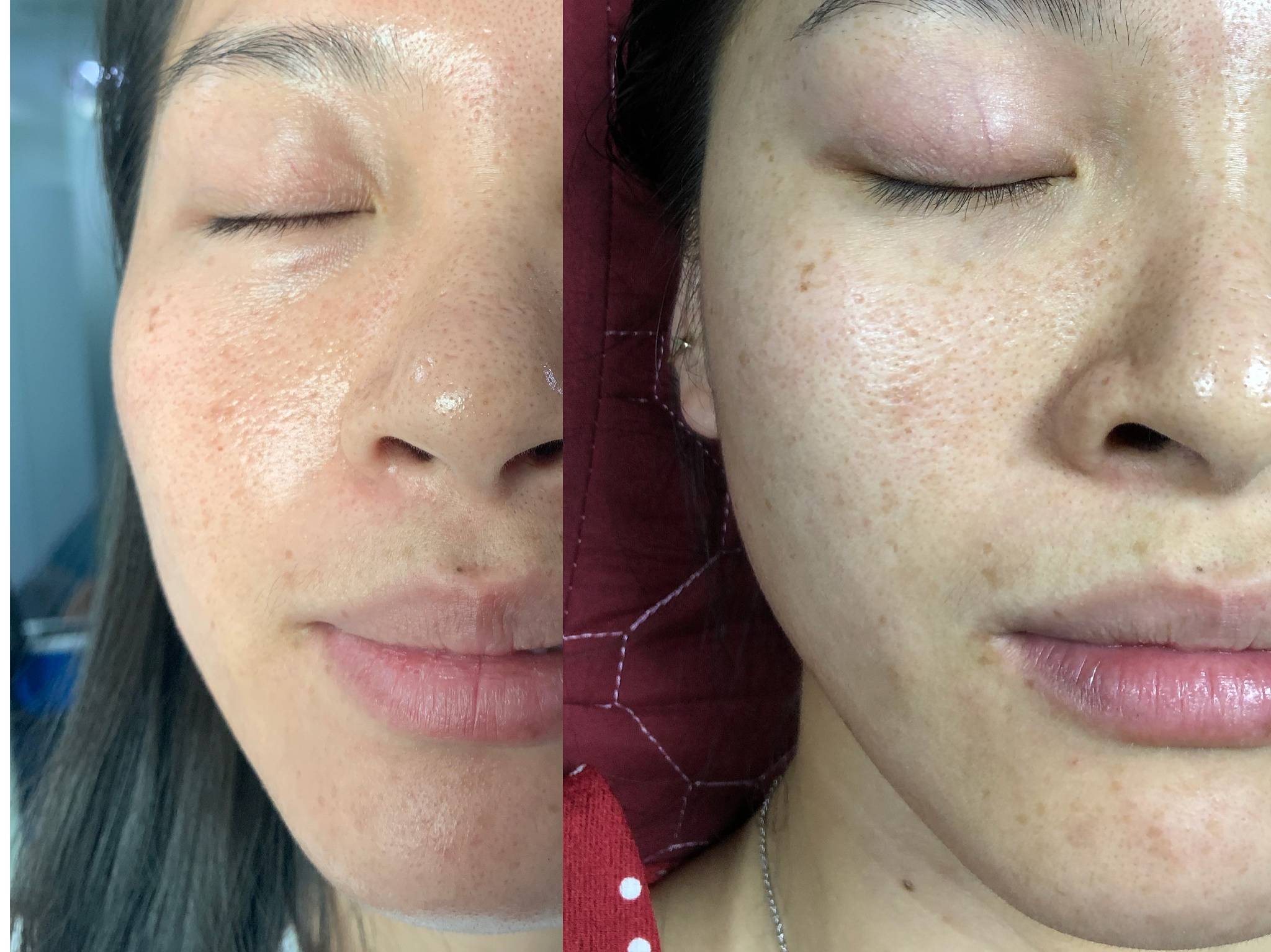 怎样才能快速祛斑去黑色素 2b4cefe0ada845fd80b8a91fcd5a5b32.jpeg