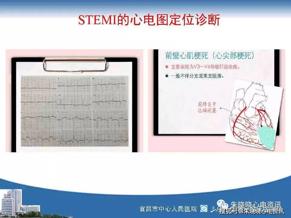 急性冠脉综合征心电图与临床ppt