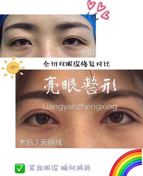 郑州整形排名_郑州元素酒窝整形图片(3)