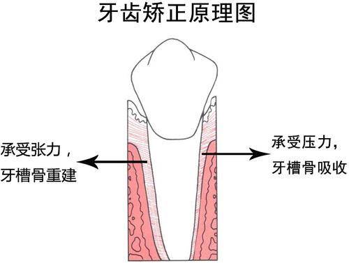 正畸牙齿移动的原理_正畸中牙齿移动的原理