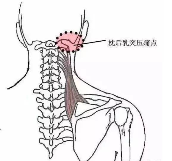 颈椎压痛点的检查