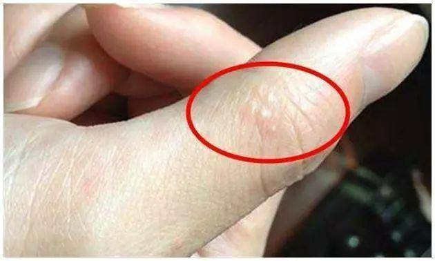 手上起小水泡是怎么回事儿 37338086021a48d59a4e973557983737.jpeg