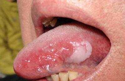 为什么会有口腔白斑 6f180c618c424922af30e43dc9e55b2e.jpeg