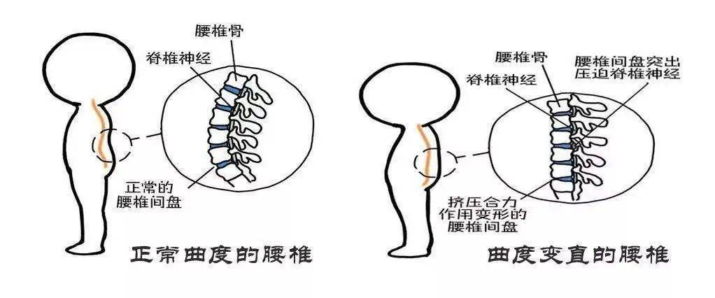 肋骨外翻超突出 瑜伽帮你练就傲人体态