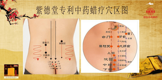 紫德堂专利中药蜡疗在临床中调理慢性腰肌劳损的方法介绍