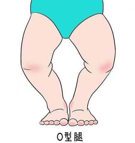 宝宝|会不会导致O型腿？预防O型腿做好这3点婴儿一直用尿不湿