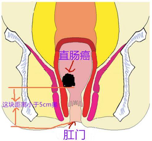 低位直肠癌,顾名思义,就是位置很低的直肠癌. 怎么个低 ??