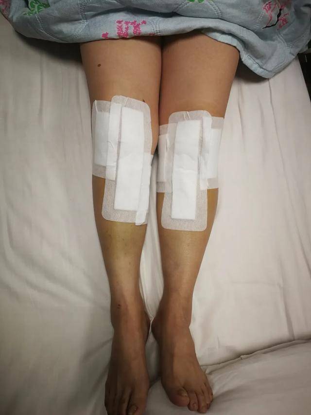 骨科汾东二病区完成双膝关节镜下清理合并双侧胫骨高位截骨保膝术