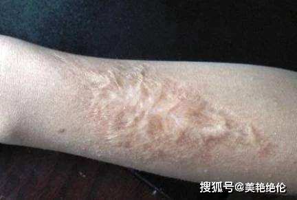 颜次方小知识：疤痕可以分为几种？