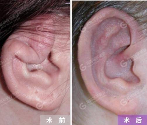 关于耳廓畸形，这几种耳形一定要引起重视！