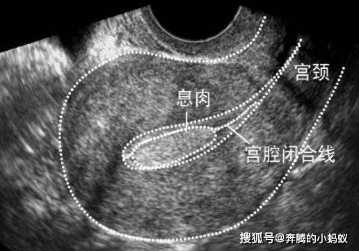 阴道口有息肉怎么办