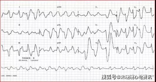 血钾异常的心电图表现,最经典的在这里!
