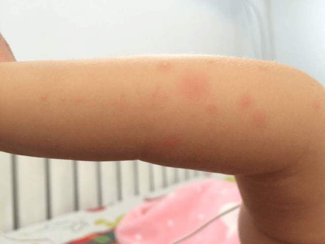 蚊子|打响宝宝防蚊保卫战蚊子喜欢O型血宝宝？宝妈做好准备
