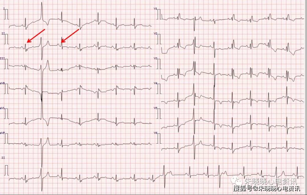 心电图病例挑战赛(第二期)答案