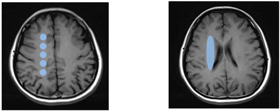 分水岭脑梗死的 ct 表现:梗死病灶在 ct 平扫上