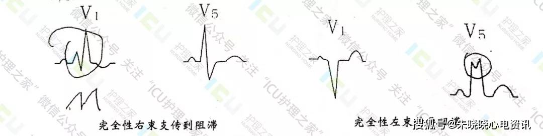 心电图这样读图,没有不会的!_手机搜狐网