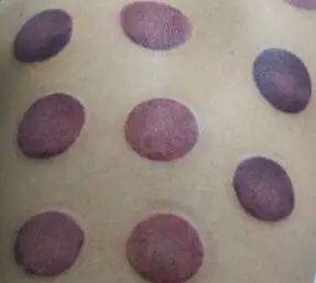 拔罐为什么是黑紫色 8fc63f916e4b4d50810c98441caa210f.jpeg