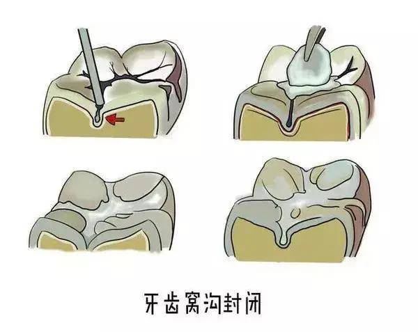 爸妈|惨！小孩1月内牙齿全部掉光！只因爸妈不注意这件事情...