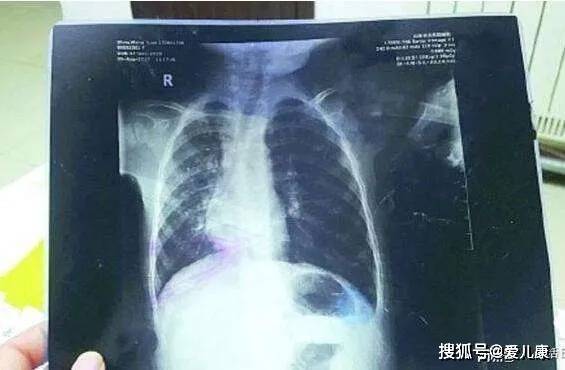 医生|我差点害死了我的儿子”这个错，每个家长都可能会犯“因为一个疏忽