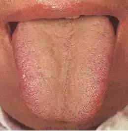 13,黄腻苔(3)本图患者胆道感染,舌苔黄腻,提示肝胆有湿热蕴结.