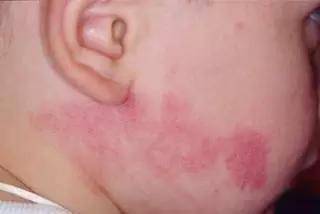 孩子各种胎记、血管瘤、斑、痣全面分析！