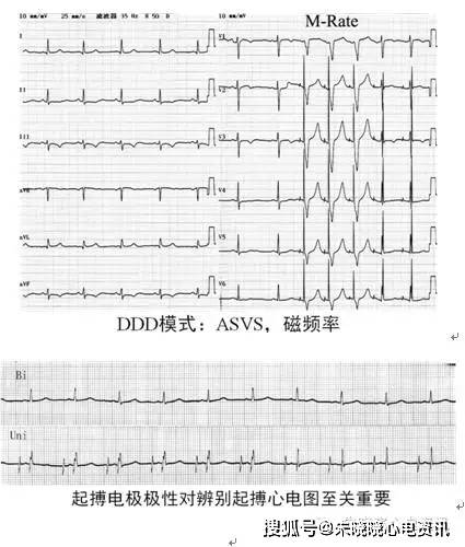 ①起搏时,每个心脏除极波(p波或qrs波)前均有一个脉冲钉信号; ②感知