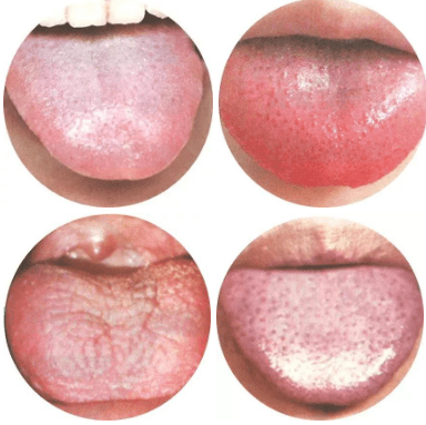 舌苔出现这些异常症状,你要引起注意了