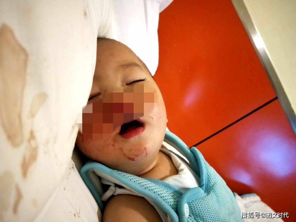 肿瘤|最终查出罕见肿瘤，妈妈：我只想让他活着1岁男童鼻子流血不止