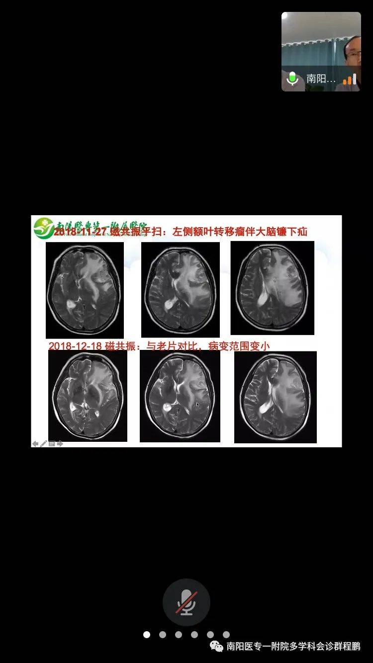 南阳医专一附院脑转移瘤mdt第一期暨肿瘤mdt第四十九期总结