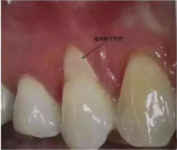 广州夕阳红口腔| 牙医,我的牙龈萎缩了,能再恢复吗?