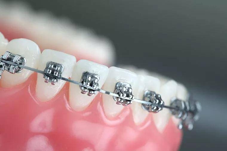关于宝安牙齿矫正的八大误区:越老时间越长,越贵越好?