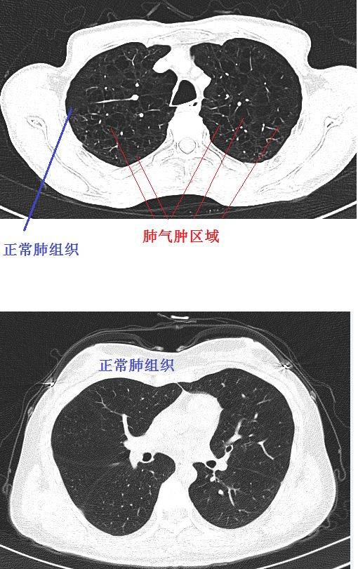 经典图谱 实战图谱,一文看懂肺气肿!