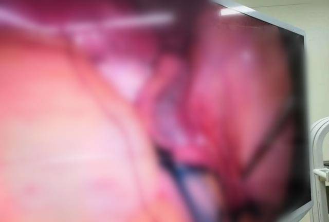 太原中心医院妇科个体化手术方案、娴熟腹腔镜术解决患者难言之痛