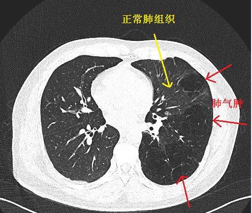 经典图谱 实战图谱,一文看懂肺气肿!