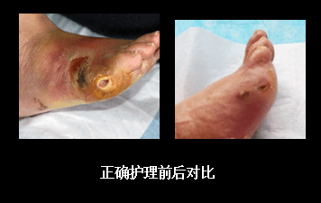 糖尿病足的护理这样做会更严重糖尿病足坏疽吃什么药能好