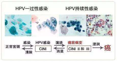 宫颈活检感染了怎么办