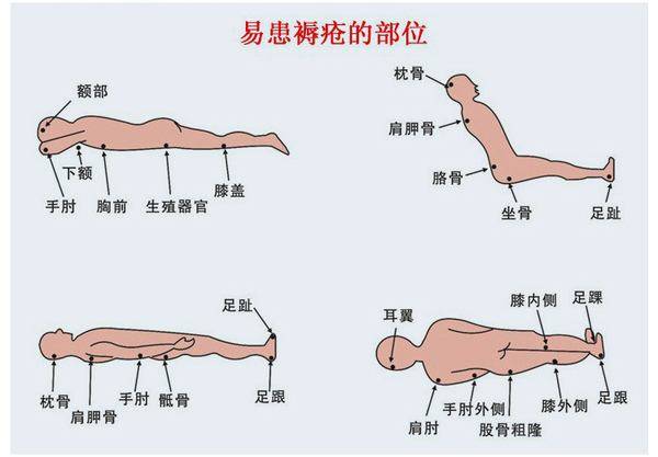 褥疮治疗过程当中容易出现的十大误区