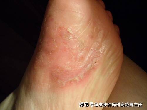 银屑病患者脚部皮肤非常干燥,发痒,有明显的红色斑块,斑块较厚,上面有