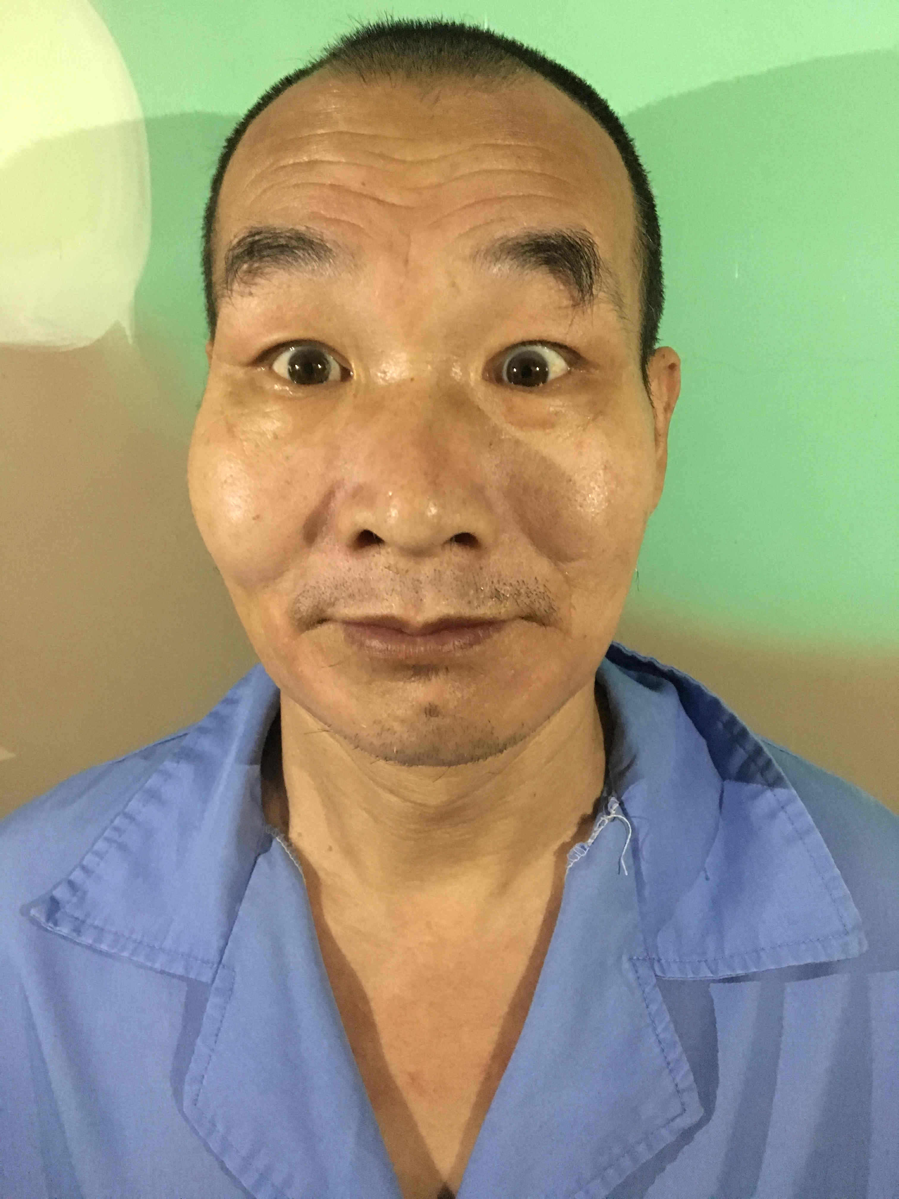 30号:市救助站明民岗,男,约50岁,双眼有轻微斗鸡眼症状,2019年4月15日