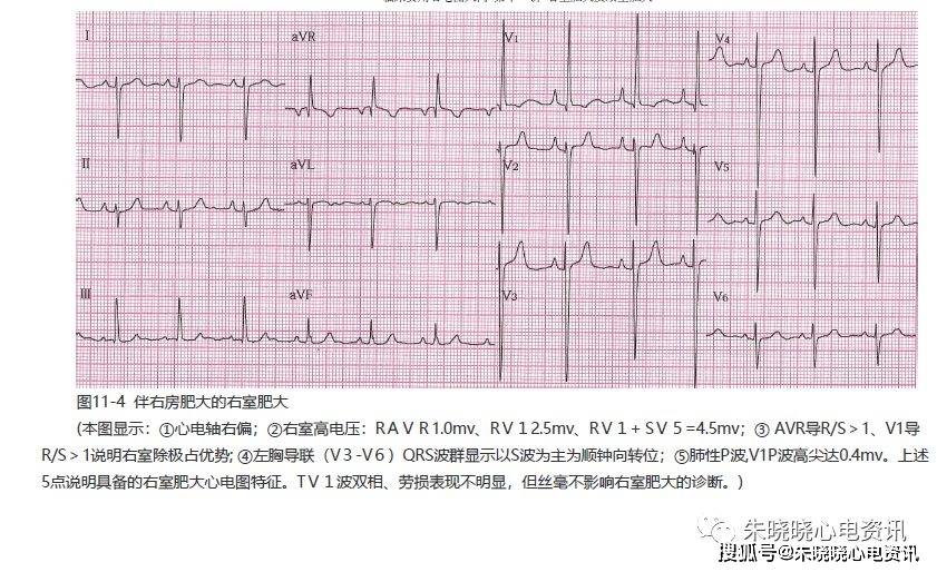 第十一讲:右室肥大及双室肥大