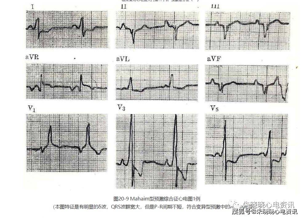 第二十讲:预激综合征(一)