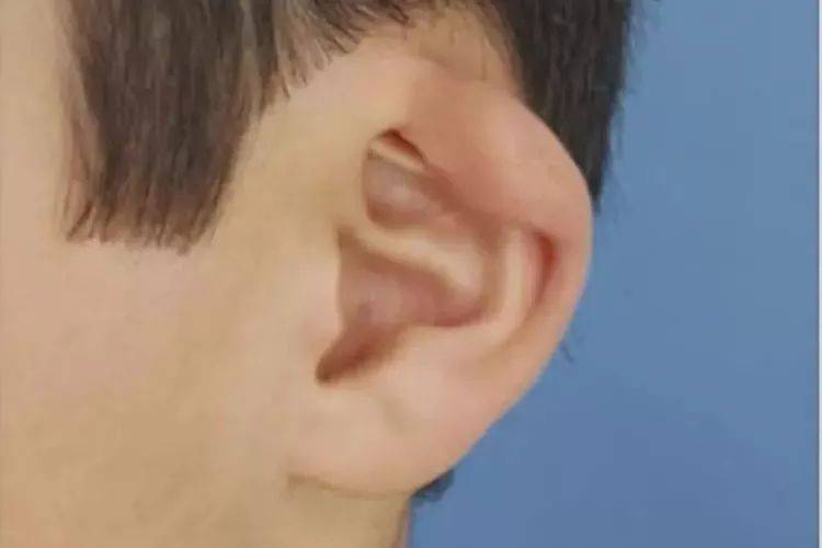 杯状耳?一招让你辨别8种外