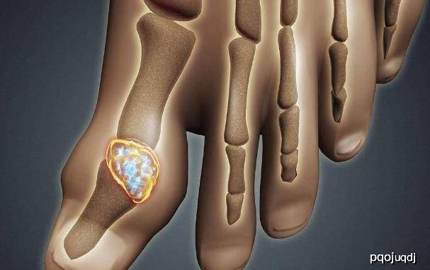 肾结石是属于肾功能不全吗 d23be2f01956466daf78d737e16bf19c.jpeg