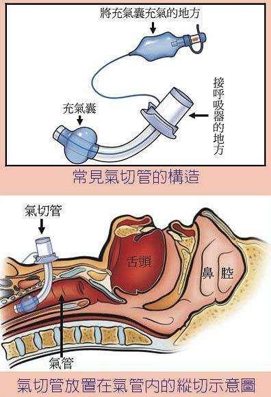 家属担心的割喉叫气管切开医生提醒8类人要做并不危险