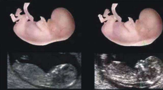 孕妈烟不离手，孕检时看到胎儿形状，医生都吓懵了